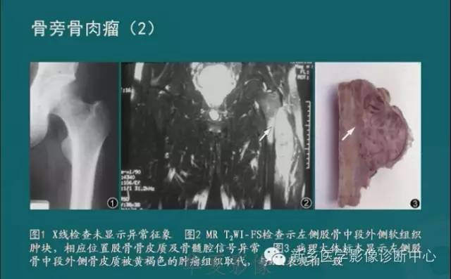 骨骼肌肉病变的基本征象——骨密度减低征象分析