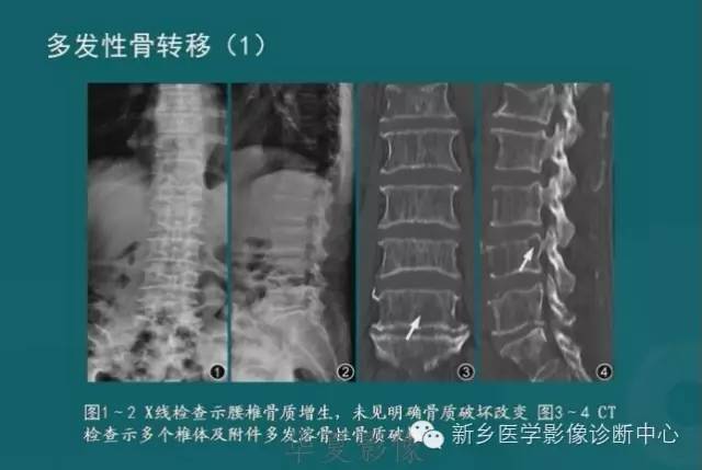 骨骼肌肉病变的基本征象——骨密度减低征象分析