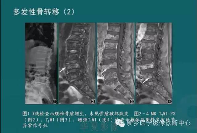 骨骼肌肉病变的基本征象——骨密度减低征象分析