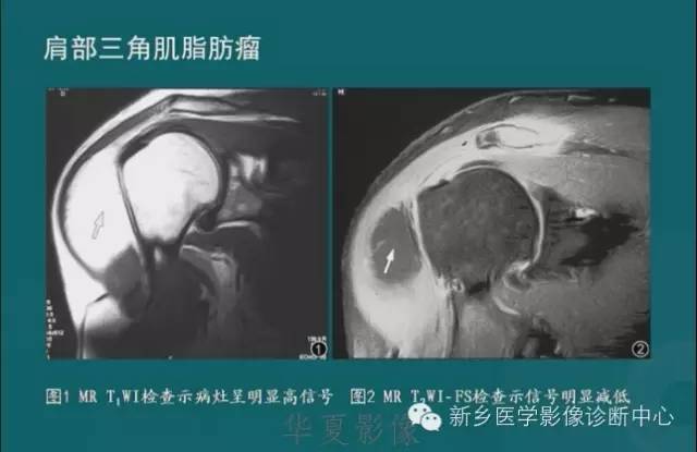 骨骼肌肉病变的基本征象——骨密度减低征象分析