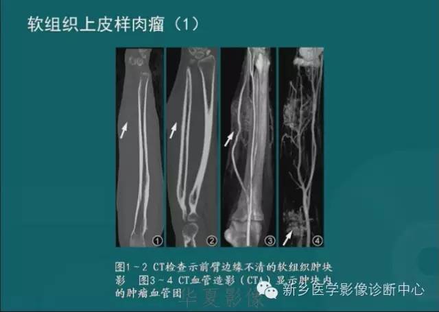 骨骼肌肉病变的基本征象——骨密度减低征象分析