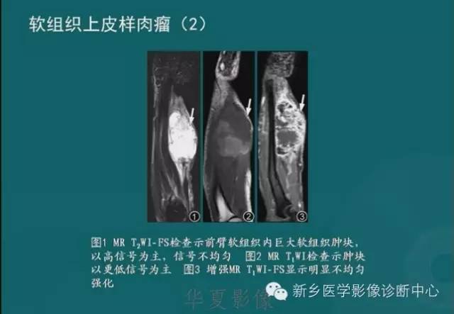 骨骼肌肉病变的基本征象——骨密度减低征象分析