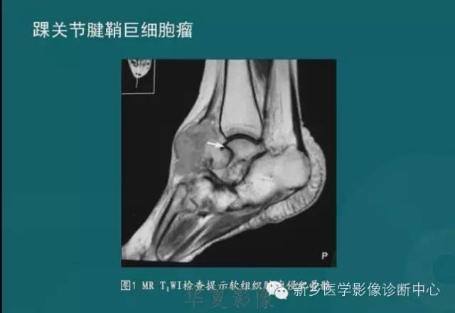 骨骼肌肉病变的基本征象——骨密度减低征象分析