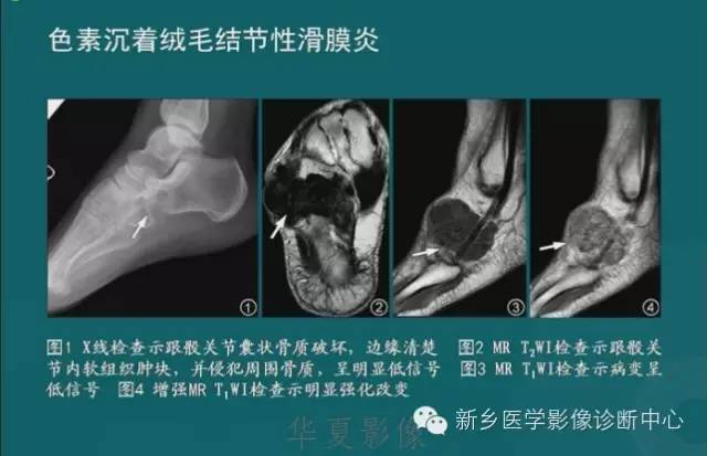 骨骼肌肉病变的基本征象——骨密度减低征象分析