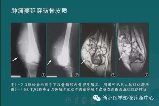 骨骼肌肉病变的基本征象——骨密度减低征象分析
