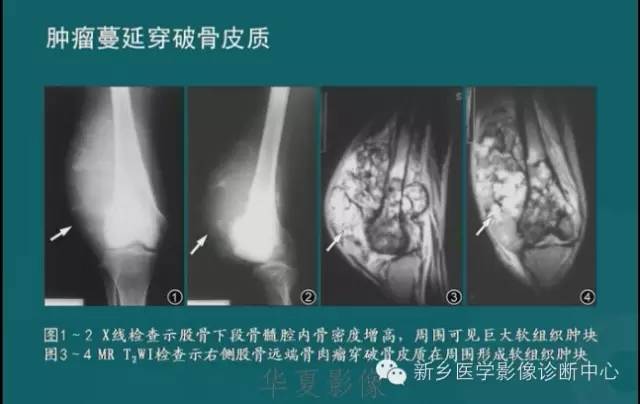 骨骼肌肉病变的基本征象——骨密度减低征象分析