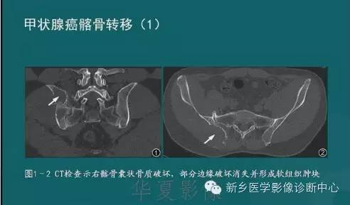 骨骼肌肉病变的基本征象——骨密度减低征象分析