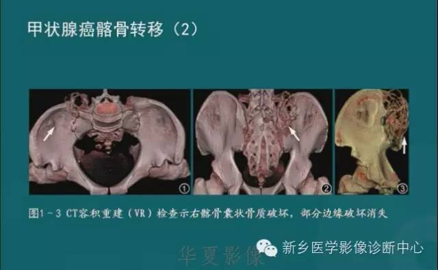 骨骼肌肉病变的基本征象——骨密度减低征象分析