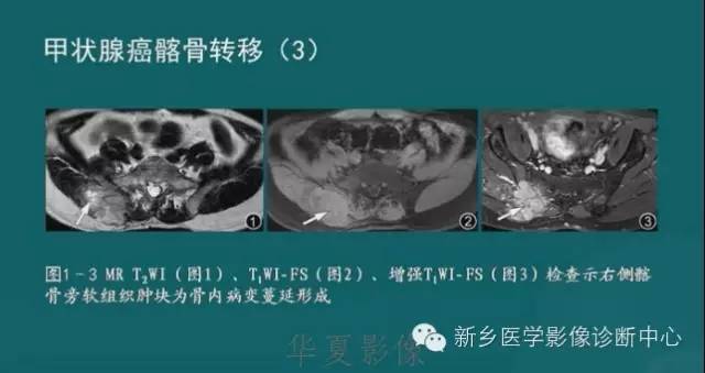 骨骼肌肉病变的基本征象——骨密度减低征象分析