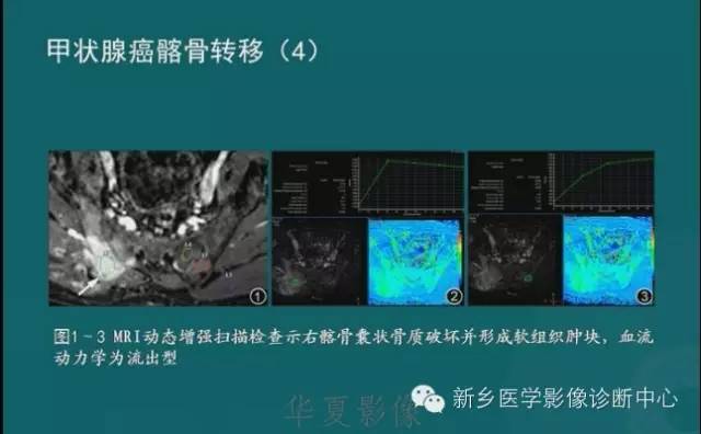 骨骼肌肉病变的基本征象——骨密度减低征象分析