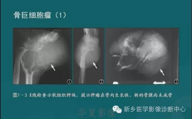 骨骼肌肉病变的基本征象——骨密度减低征象分析