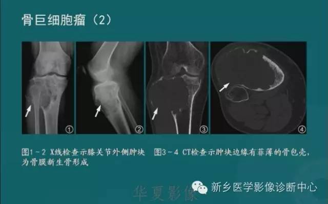 骨骼肌肉病变的基本征象——骨密度减低征象分析