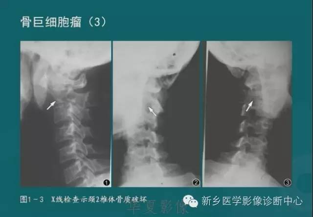 骨骼肌肉病变的基本征象——骨密度减低征象分析