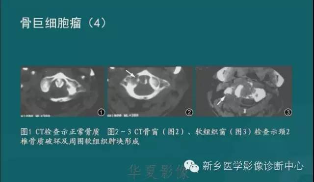 骨骼肌肉病变的基本征象——骨密度减低征象分析