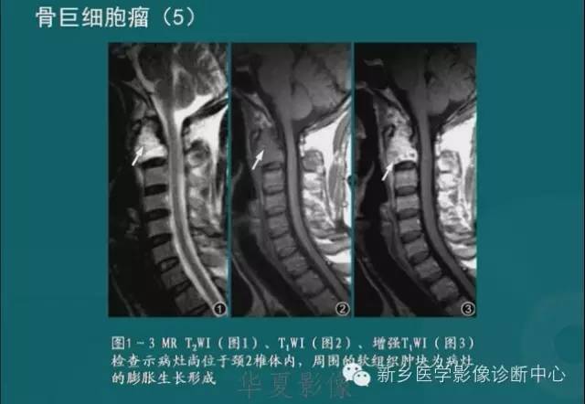 骨骼肌肉病变的基本征象——骨密度减低征象分析