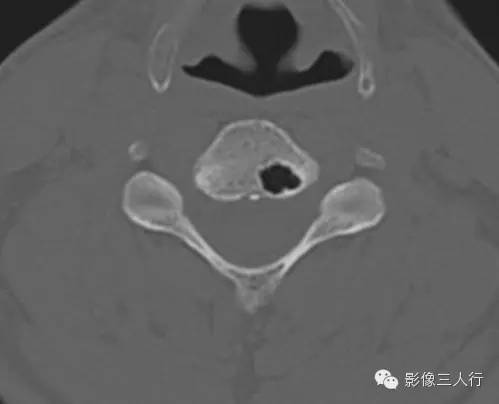 椎体含气囊肿