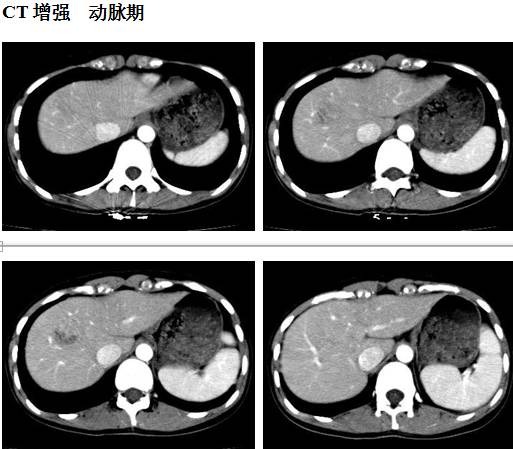 【病例】肝脏血管平滑肌脂肪瘤1例CT影像表现 【病例】肝脏血管平滑肌脂肪瘤1例CT影像表现