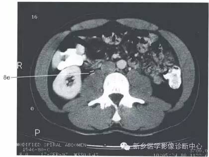 上腹部一些正常影像数据