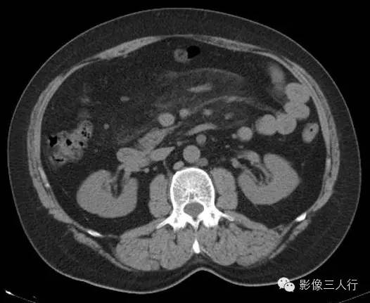 肠系膜脂膜炎mesenteric panniculitis