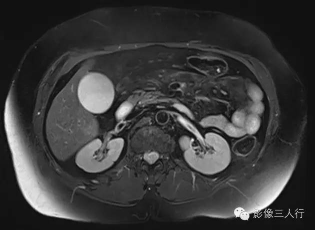 肠系膜脂膜炎mesenteric panniculitis 肠系膜脂膜炎mesenteric panniculitis