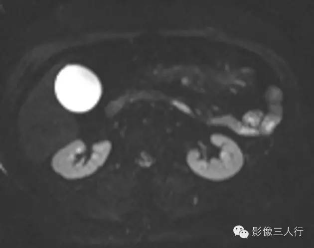 肠系膜脂膜炎mesenteric panniculitis 肠系膜脂膜炎mesenteric panniculitis