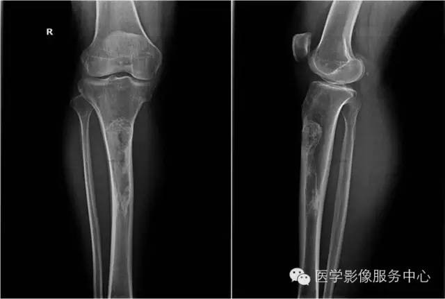 【病例】胫骨骨纤维结构不良1例MR影像表现 【病例】胫骨骨纤维结构不良1例MR影像表现