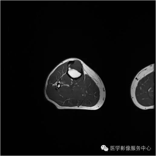 【病例】胫骨骨纤维结构不良1例MR影像表现 【病例】胫骨骨纤维结构不良1例MR影像表现