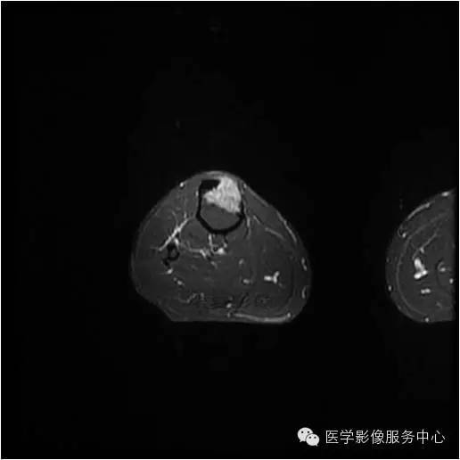 【病例】胫骨骨纤维结构不良1例MR影像表现 【病例】胫骨骨纤维结构不良1例MR影像表现
