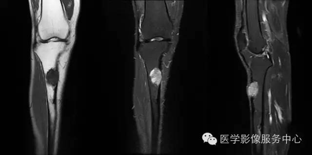 【病例】胫骨骨纤维结构不良1例MR影像表现