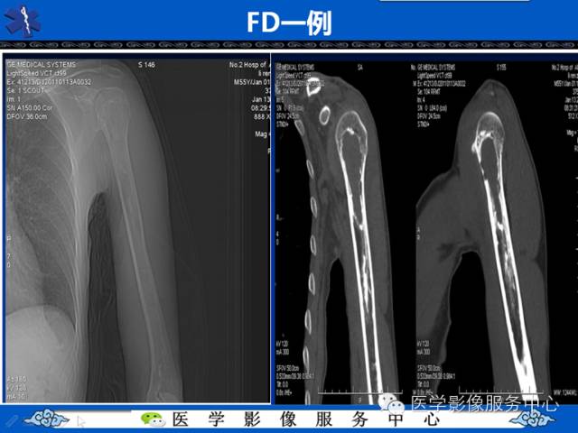 【病例】胫骨骨纤维结构不良1例MR影像表现 【病例】胫骨骨纤维结构不良1例MR影像表现
