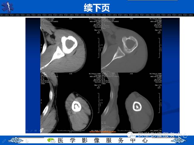 【病例】胫骨骨纤维结构不良1例MR影像表现 【病例】胫骨骨纤维结构不良1例MR影像表现