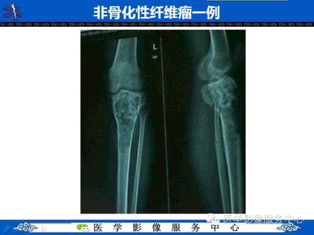 【病例】胫骨骨纤维结构不良1例MR影像表现 【病例】胫骨骨纤维结构不良1例MR影像表现