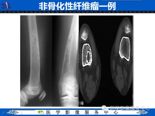 【病例】胫骨骨纤维结构不良1例MR影像表现 【病例】胫骨骨纤维结构不良1例MR影像表现
