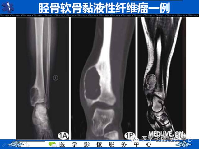 【病例】胫骨骨纤维结构不良1例MR影像表现 【病例】胫骨骨纤维结构不良1例MR影像表现