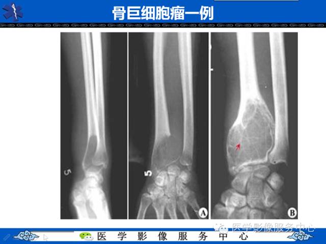【病例】胫骨骨纤维结构不良1例MR影像表现 【病例】胫骨骨纤维结构不良1例MR影像表现