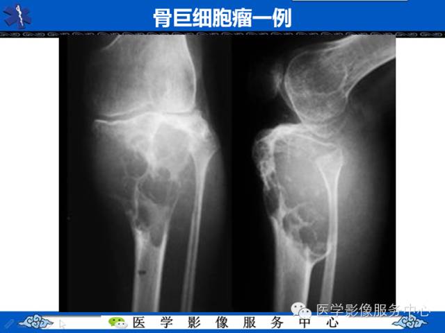 【病例】胫骨骨纤维结构不良1例MR影像表现 【病例】胫骨骨纤维结构不良1例MR影像表现
