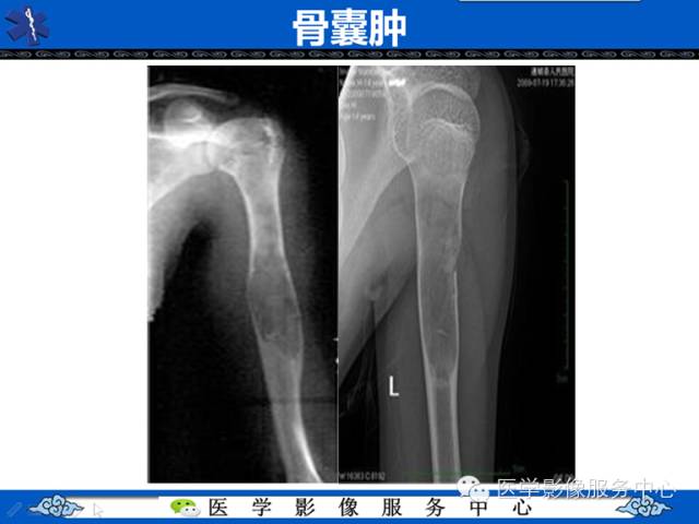 【病例】胫骨骨纤维结构不良1例MR影像表现 【病例】胫骨骨纤维结构不良1例MR影像表现