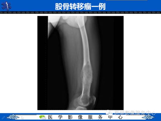 【病例】胫骨骨纤维结构不良1例MR影像表现 【病例】胫骨骨纤维结构不良1例MR影像表现
