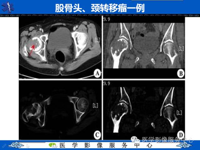 【病例】胫骨骨纤维结构不良1例MR影像表现 【病例】胫骨骨纤维结构不良1例MR影像表现