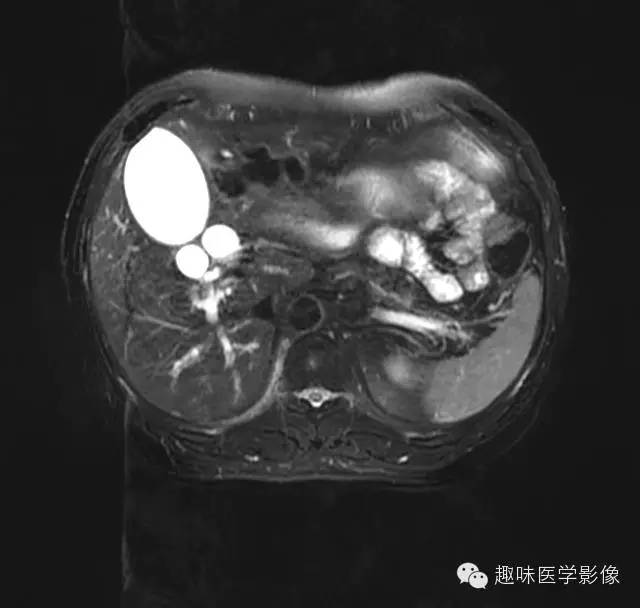 【病例】胰头癌1例MR影像表现