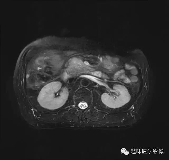 【病例】胰头癌1例MR影像表现 【病例】胰头癌1例MR影像表现