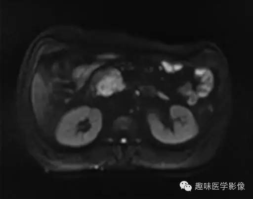 【病例】胰头癌1例MR影像表现 【病例】胰头癌1例MR影像表现