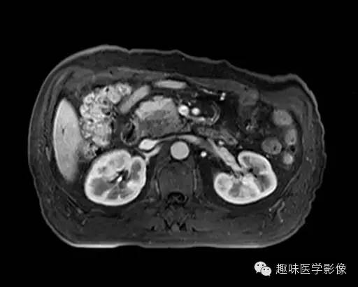 【病例】胰头癌1例MR影像表现 【病例】胰头癌1例MR影像表现