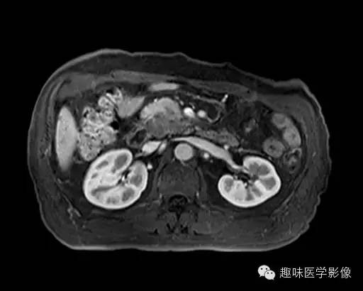 【病例】胰头癌1例MR影像表现 【病例】胰头癌1例MR影像表现