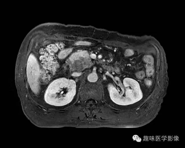 【病例】胰头癌1例MR影像表现 【病例】胰头癌1例MR影像表现