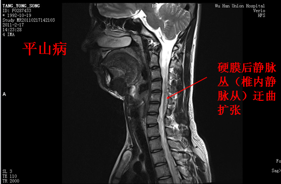 椎管解剖