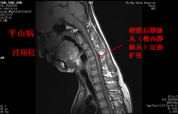 椎管解剖