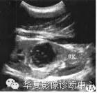 【病例】肾脏滑膜肉瘤1例CT影像表现 【病例】肾脏滑膜肉瘤1例CT影像表现
