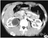【病例】肾脏滑膜肉瘤1例CT影像表现