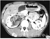 【病例】肾脏滑膜肉瘤1例CT影像表现 【病例】肾脏滑膜肉瘤1例CT影像表现
